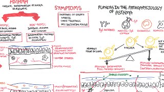 Asthma  signs and symptoms pathophysiology [upl. by Yspyg]