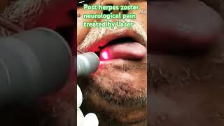 Herpes zoster treated by Laser [upl. by Eahsel]