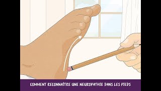 Comment reconnaître une neuropathie dans les pieds [upl. by Mehalek]