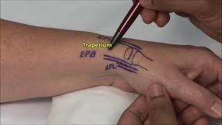 1st CMC Joint Injection [upl. by Higgins]