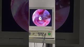 TTube Part3 hearingloss eardischarge tinnitus amazing [upl. by Ahsetan68]