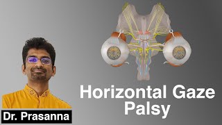 Horizontal Gaze Palsy [upl. by Corissa]