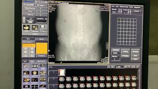 Intravenous Pyelogram I CECT KUB  CT Pyelogram CTU planning and procedure discoveryzsm7667 [upl. by Brunhilda493]