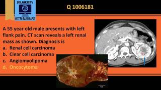 Renal oncocytoma central stellate scar [upl. by Kelci]