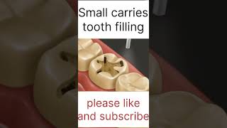 Small carries tooth filling asmr 3d localdentistry cavityfilling youtubeshorts ytshortsindia [upl. by Thirzi]