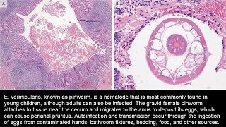 Enterobius vermicularis Madenwurm im Appendix [upl. by Cruce]