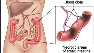 Mesenteric Ischemia [upl. by Munson]