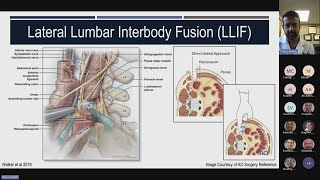 Neuromonitoring during LLIF The Past the Present and the Future presented b Ashish Patel MD [upl. by Azilanna]