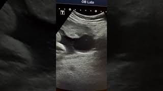 Placental cyst Ultrasound in 3rd trimester pregnancy ARDMD sonography [upl. by Edgard]