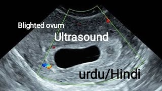 Blighted OvumAnembryonic Pregnancy on ultrasound [upl. by Annekahs]