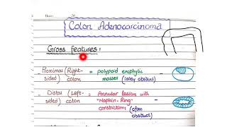 Colon Adenocarcinoma  Morphology [upl. by Animrelliug594]