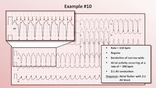 Intro to EKG Interpretation  Practicing Tachyarrhythmia Identification [upl. by Immac]