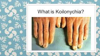 WHAT TO KNOW ABOUT KOILONYCHIA  NAIL DEFORMITIES  CLINICAL MEDICINE  MBBS REVISION GUIDE [upl. by Lednyc150]