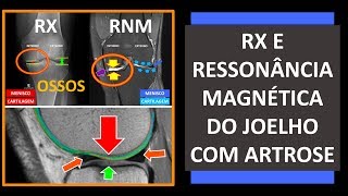 RX E RESSONÂNCIA MAGNÉTICA DO JOELHO COM ARTROSE [upl. by Hazeefah]