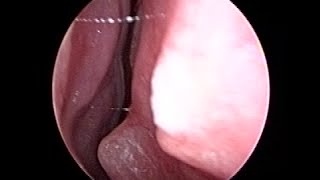 Very Acute Spur with Deviated Nose Septum on Nose Endoscopy [upl. by Aitercul182]