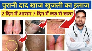 जांघों की दाद खाज खुजली खत्म  Home Remedies For Itching in Private Parts  Fungal infection [upl. by Eniac]