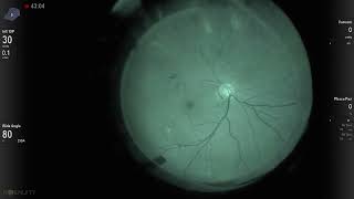 Clip 5  Intraoperative Fluorescein Angiography in BRVO [upl. by Andonis]