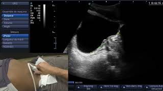 Index de protrusion prostatique en échographie [upl. by Niwroc231]