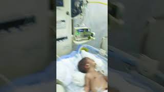 Gavage feeding in baby Nasogastric tube feeding in baby cpap neonatalcare helth [upl. by Elleniad]