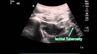 Procedimiento para el bloqueo del nervio ciático a nivel subglúteo ecoguiado [upl. by Tobye630]