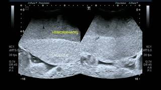 Ultrasound video showing retroplacental hemorrhageplacental abruption [upl. by Eidnil673]