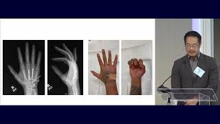 15 Metacarpal and Phalangeal Fractures Nicolas Lee MD 020 [upl. by Marcelline]