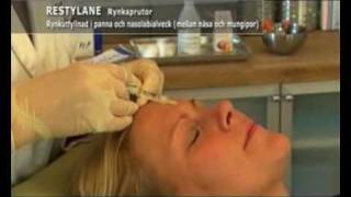 Restylane och Botox behandling [upl. by Grange]