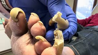 Unbelievable Toenails so long and painful that patient cannot walk [upl. by Bui]