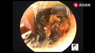 Oil cerumen and dry cerumen cleaning 9 minutes [upl. by Analem]