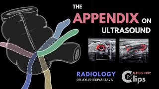 The Appendix on ultrasound and Acute appendicitis  Radiology [upl. by Joris]