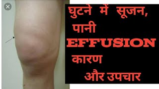 Swelling  edema effusion in Knee joint Hindi  घुटने में पानी भरना सूजन का इलाज knee pain ACL [upl. by Fredra62]