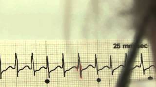 EKG für Pflege Teil 19  Supraventrikuläre Tachykardie interpretieren [upl. by Alrats]