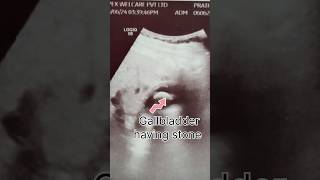 Ultrasound whole abdomen male organs  USG IMAGES youtubeshorts [upl. by Frolick595]