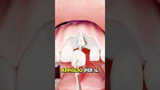 COME FUNZIONA IL TRAPIANTO DI DENTI credits ​⁠zackdfilms [upl. by Nodnarbal]