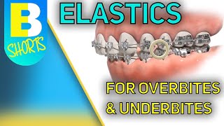 Braces Elastics for Overbite and Underbite shorts [upl. by Hudnut]