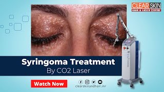 CO2 Laser treatment for Syringomas  Best Laser Treatment For Syringomas  DrNKailash  Kurnool [upl. by Arvad]