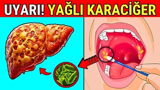 KARACİĞERİNİZİN YAĞLANDIĞINI GÖSTEREN 14 İŞARET  2 Bölüm [upl. by Yaras]