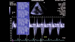 Congenital Pulmonic Valve Stenosis  Transthoracic Echocardiogram TTE [upl. by Ludlow]