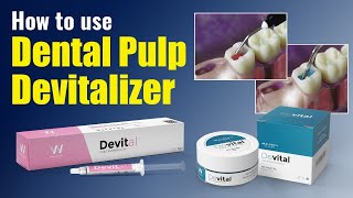 How to use Dental Pulp Devitalizer  Waldent Devital [upl. by Nylsej]