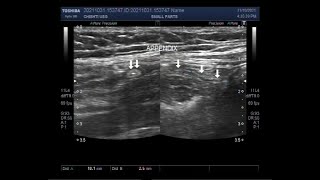 Normal Appendix and Rt Salpingitis with Lt Ovarian Chocolate Cyst [upl. by Block497]