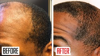 Derma Rolling for Hair Regrowth  Genuine Tips [upl. by Ytissac]