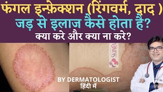 Fungal Infection In Private Parts Skin Treatment  Daad ka Ilaj Cream [upl. by Audres]