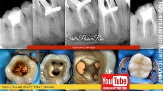 one visit endodontic retreatment mandibular molar rebilda dc spesialis konservasi gigi [upl. by Mortimer]