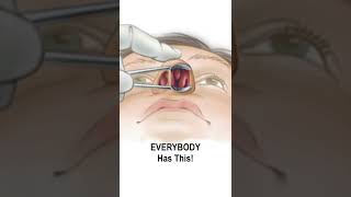 Nasal Obstruction Due to Turbinate Hypertrophy shorts fauquierent [upl. by Enrahs]