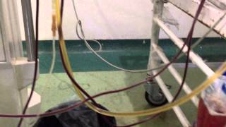 Plasmapheresis in Renal transplant with severe AMR Dr Sandeep kumar garg [upl. by Aicatsana]