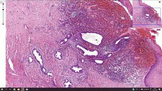 Endometriosis  Histopathology [upl. by Somerville]