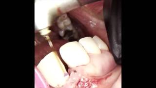 Regenerative surgery with ErCrYSGG using minimally invasive technique [upl. by Inaj]