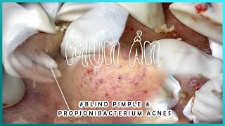 Big Cystic Acne Blackheads Extraction Blackheads amp Milia Whiteheads Removal Pimple Popping [upl. by Eirrod]