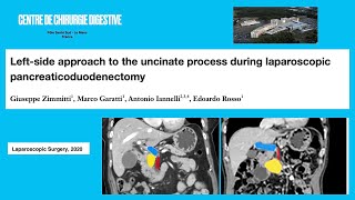 Laparoscopic Leftside approach to uncinate process during pancreaticoduodenectomy [upl. by Sisi]