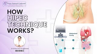 How HIPEC Technique Works  HIPEC Procedure  How Does HIPEC WorkDr Vinay Samuel Gaikwad cancer [upl. by Enier]